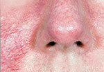 rosacea